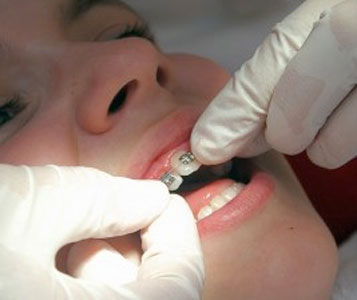 Qui paie l’orthodontiste?