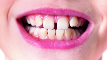 Dents du bonheur chez les enfants: frein sur la freinectomie