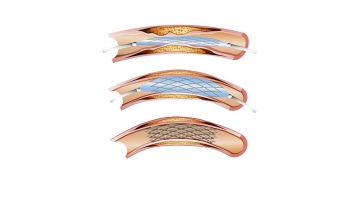 Stents: en pose-t-on trop?