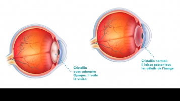 Comment choisir son implant optique?