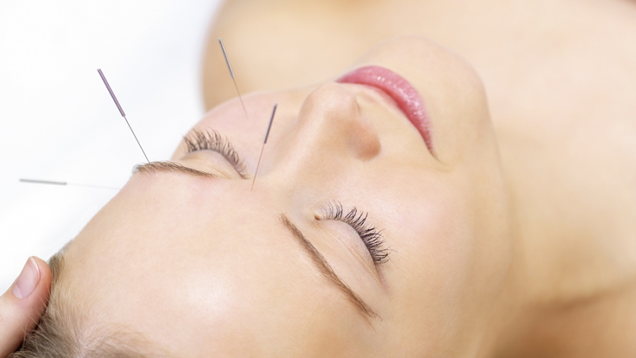 Acupuncture et LAMal