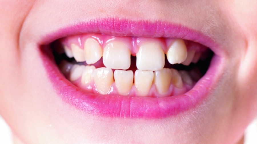 Dents du bonheur chez les enfants: frein sur la freinectomie