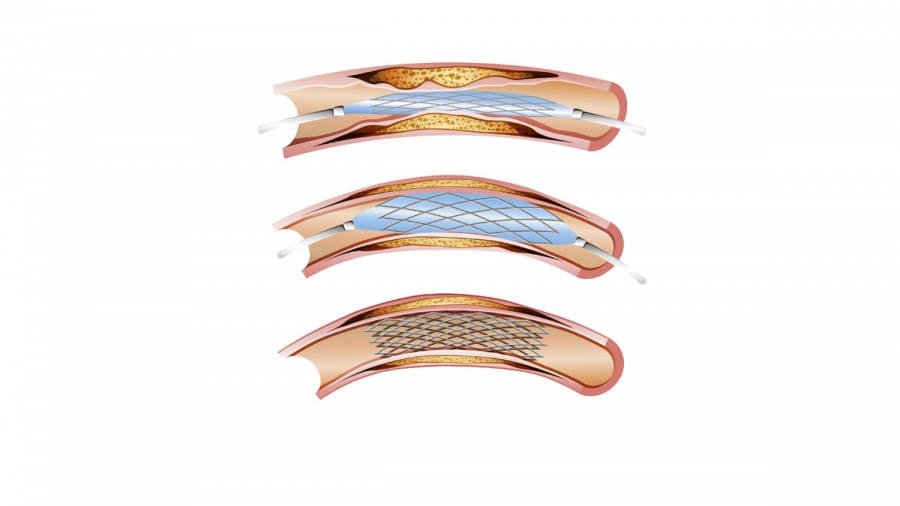 Stents: en pose-t-on trop?